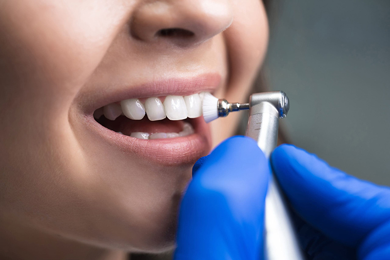 O que é Limpeza Dental no consultório?