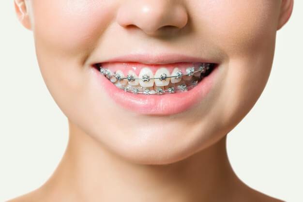 Ortodontia: Aparelho Fixo | Dentista em Sorocaba
