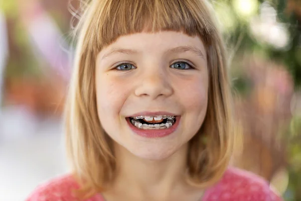 Ortodontia: Aparelho Móvel (Removível) | Dentista em Sorocaba