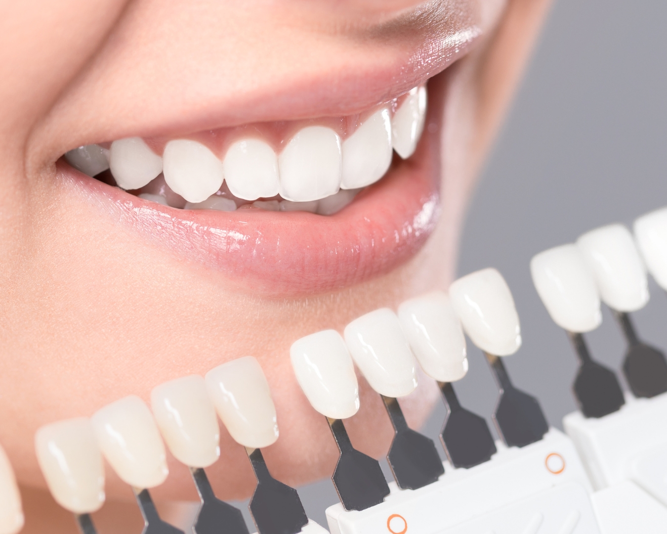 Clareamento Dental: O Que É e Como Funciona